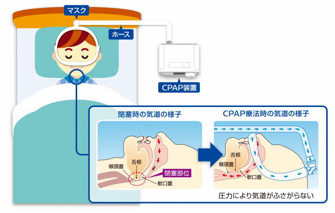 CPAP