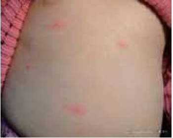 丘疹